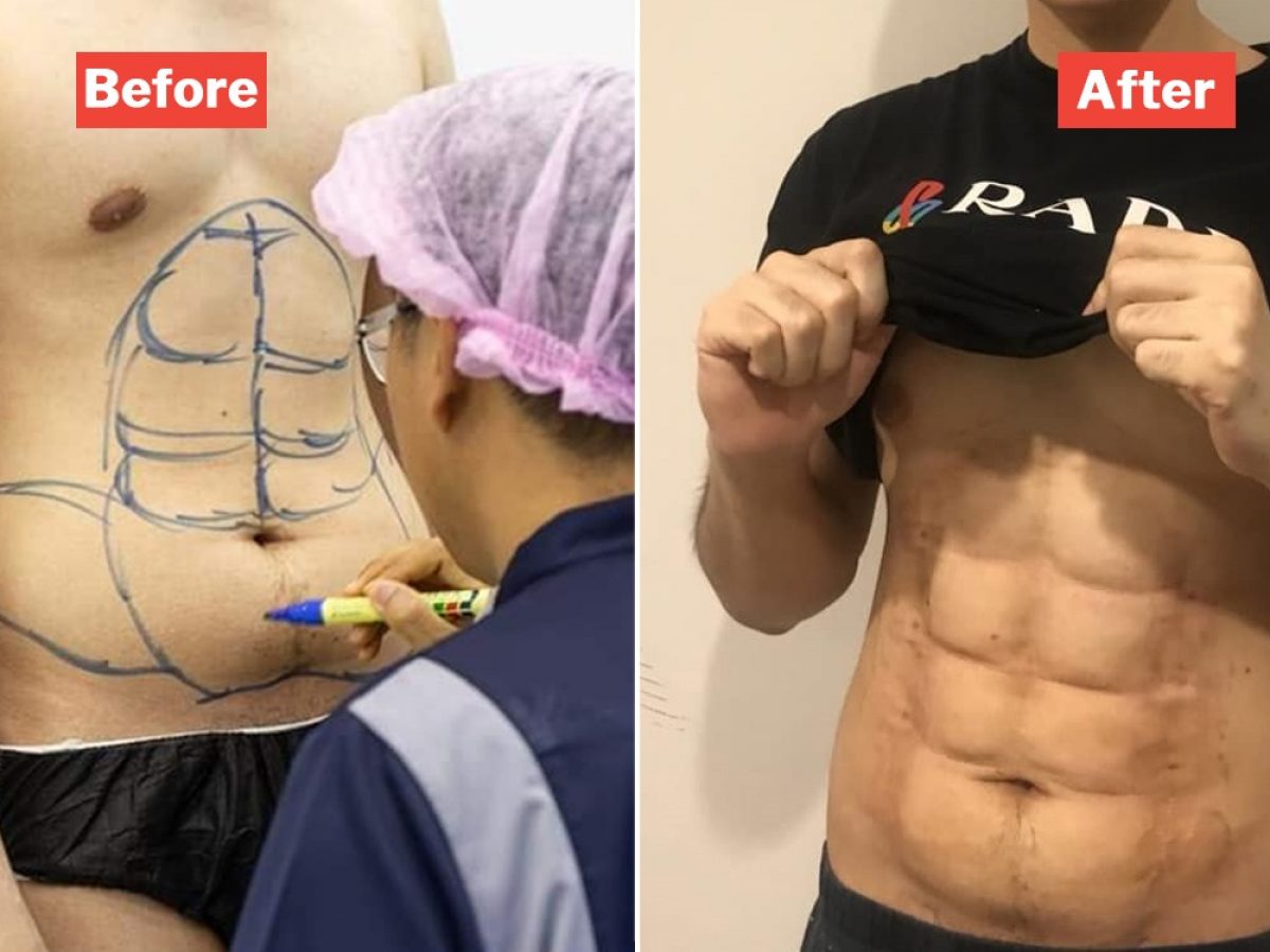 Instantly Turn Your 1 Pack Into A 6 Pack With This Cosmetic Surgery At A  Bangkok Hospital