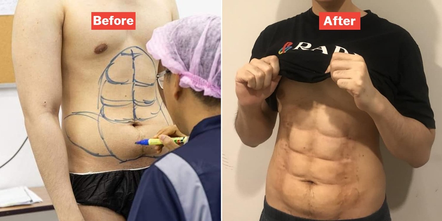 Instantly Turn Your 1 Pack Into A 6 Pack With This Cosmetic Surgery At A Bangkok Hospital