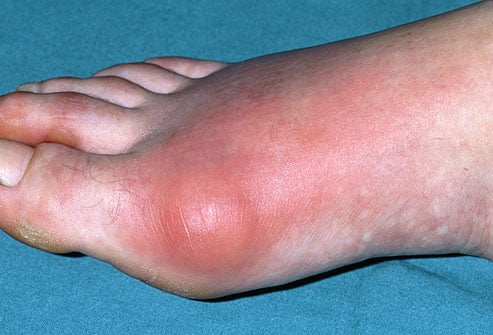 gout-singapore-younger-1.jpg