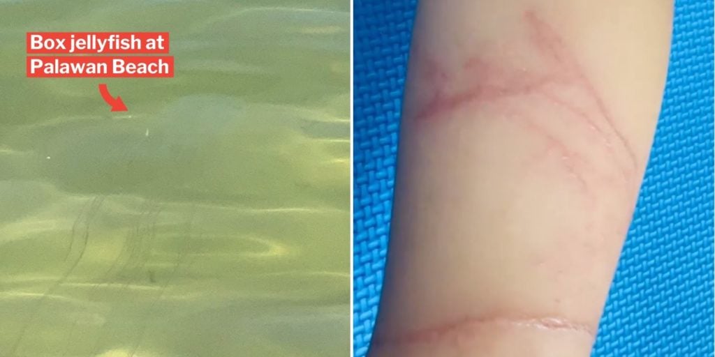 Girl Stung By Box Jellyfish In Sentosa, Public Should Avoid Waters Till ...