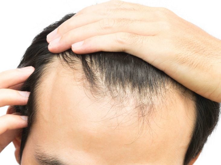 5 Ways To Spot Premature Balding As Shared By Hair Experts So You Can