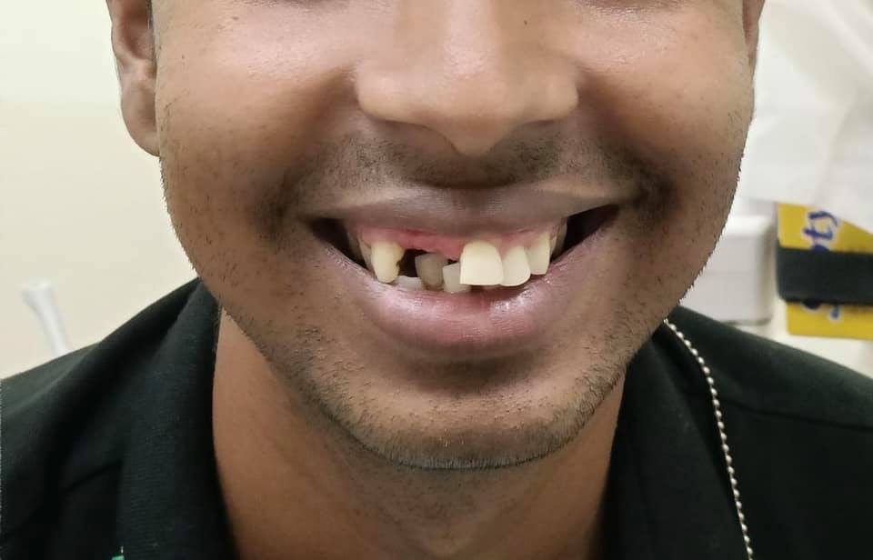 migrant worker accident teeth