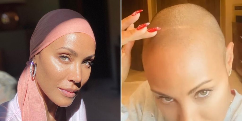 Jada Pinkett Smith's Hair Loss Is No Joke, It's A Condition Called Alopecia