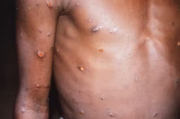 MOH monkeypox cases 