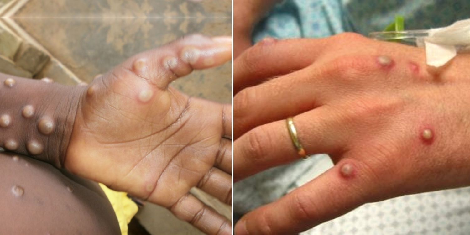 Monkeypox Cases On The Rise In Europe, US & Canada, Transmission Occurs Through Close Contact