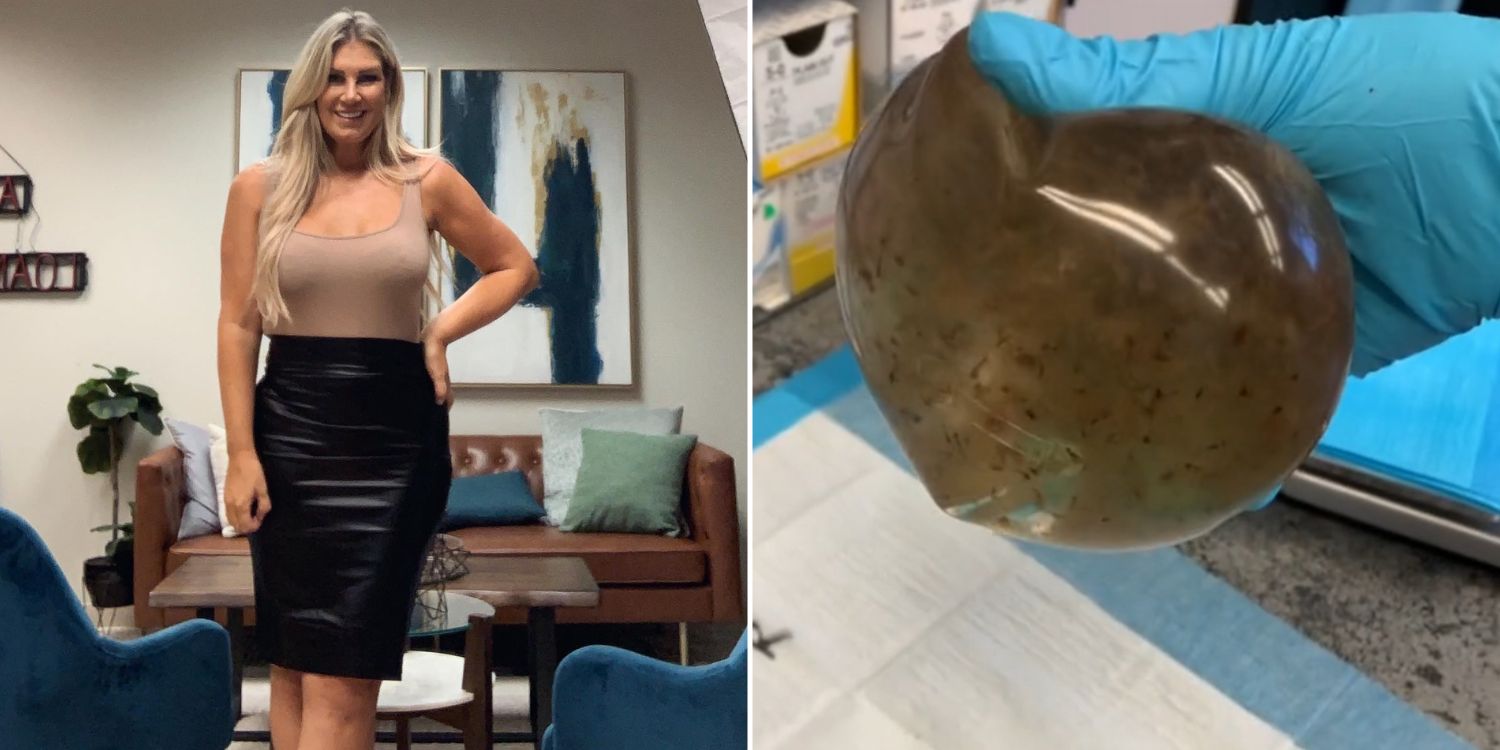 Woman Removes Breast Implants After Suffering Mysterious Ailments,  Discovers One Has Grown Mouldy