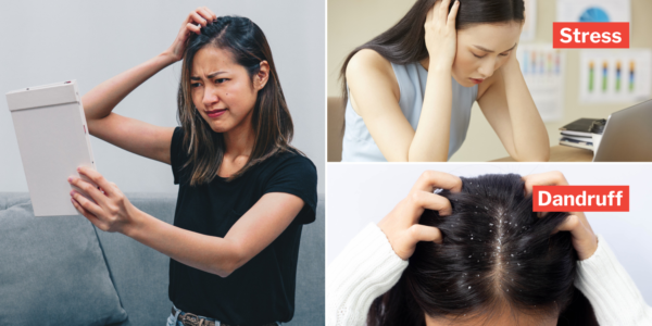 We Found Out Why Scalps Get Itchy Despite Regular Shampooing, It’s Not Just About Products