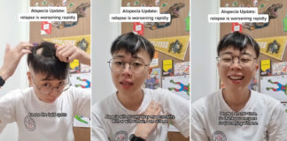 Alopecia Patient In S'pore Experiences Relapse, Wants Others With Condition To Know They Have Support