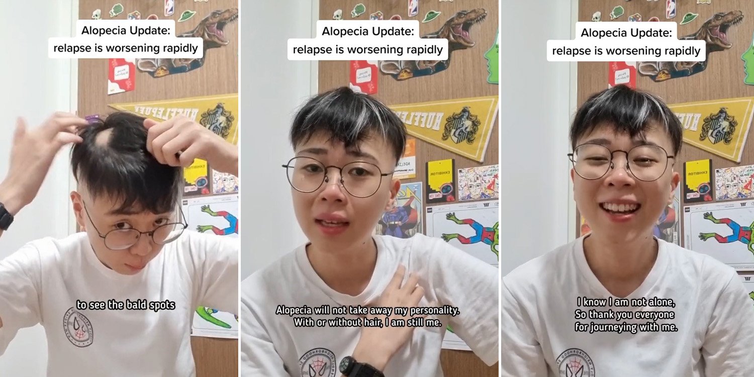 Alopecia Patient In S'pore Experiences Relapse, Wants Others With Condition To Know They Have Support