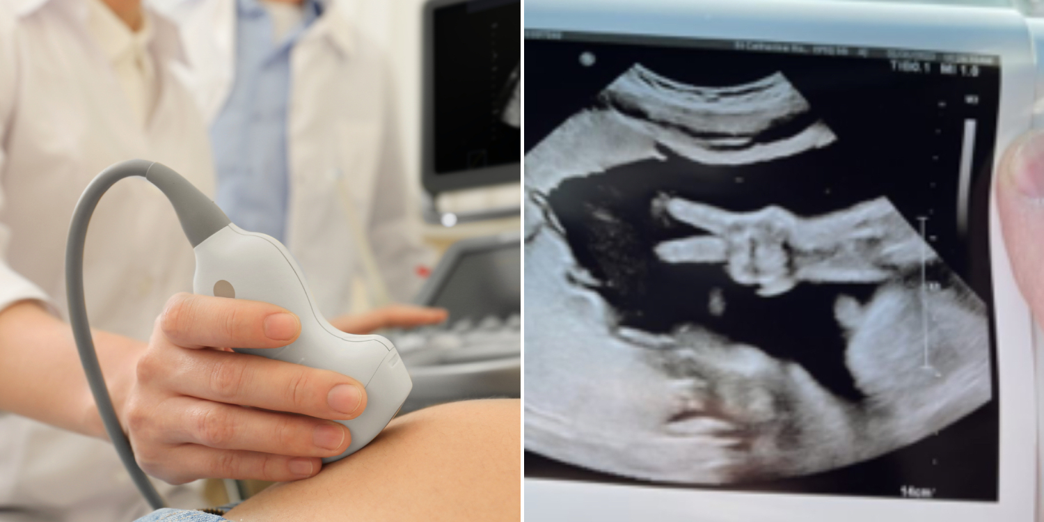 Foetus Makes 'Peace' Sign During Ultrasound In US, Medical Staff Surprised By Rare Occurrence