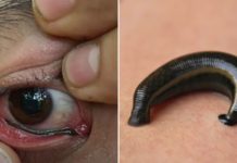 Leech Crawls Into Eye Of Thai Hiker, He Spends Over 30 Minutes Trying To Remove It