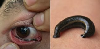 Leech Crawls Into Eye Of Thai Hiker, He Spends Over 30 Minutes Trying To Remove It