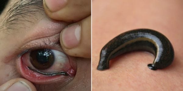 Leech Crawls Into Eye Of Thai Hiker, He Spends Over 30 Minutes Trying To Remove It