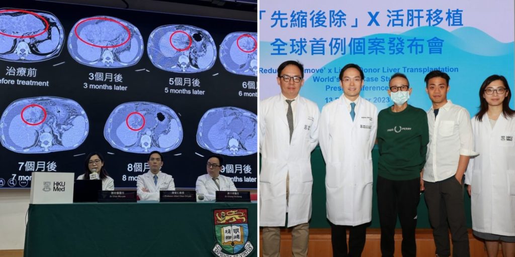 Hong Kong Researchers Reportedly Develop Late Stage Liver Cancer Treatment That Can Cure Some 8741