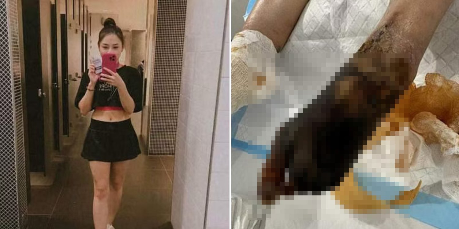 37-year-old M'sian beautician working in S'pore loses 4 limbs after bacterial infection