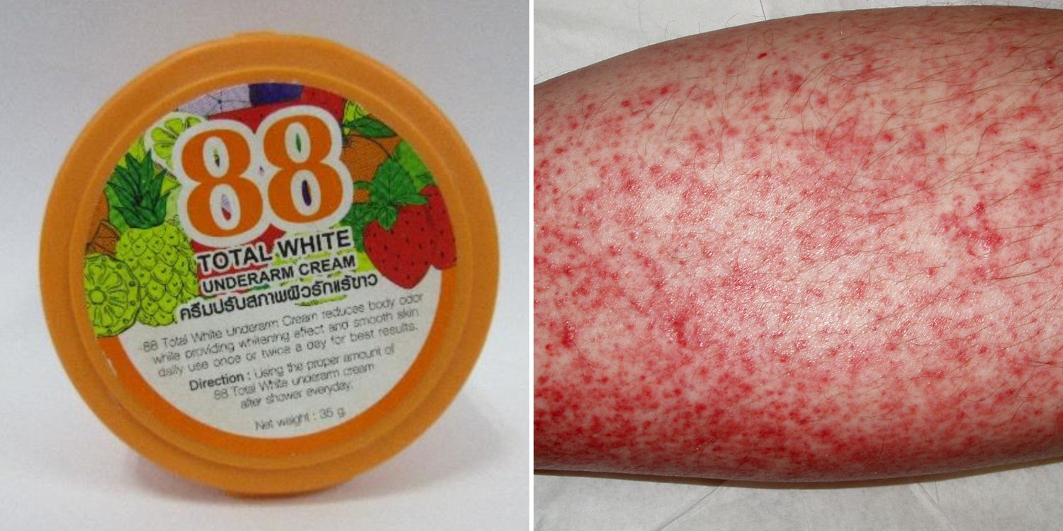 Woman suffers liver damage after using whitening cream bought from Lucky Plaza