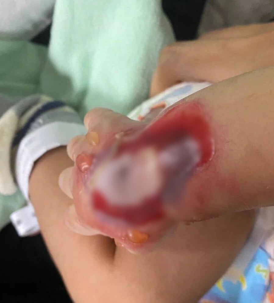 1-month-old baby scalded msia 1