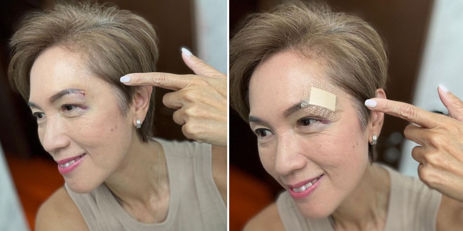 Josephine Teo suffers 1-inch gash near eye after walking into glass door