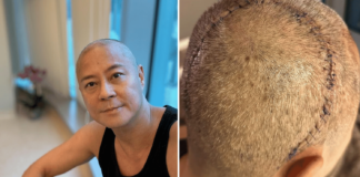 cai-yijie-brain-tumor