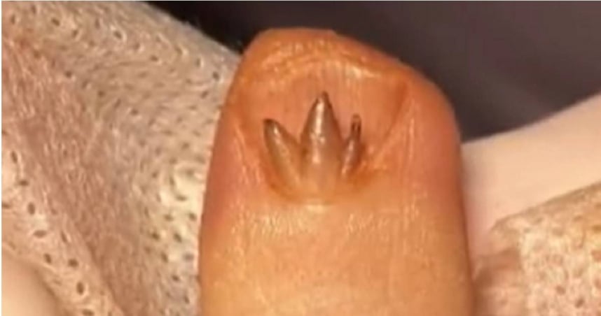 trident flesh fingernail