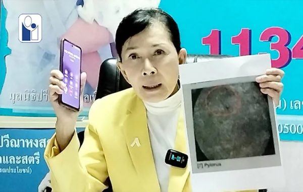 Woman in Thailand experiences pain for 18 years due to needle left in ...