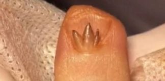 trident flesh fingernail