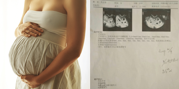 Woman in China pregnant with 9 foetuses reduces 7 for safety but loses the remaining 2