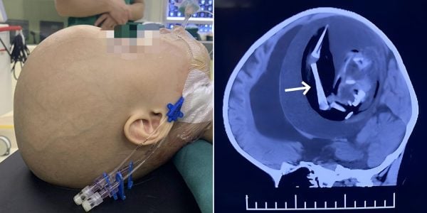 1-year-old girl in China undergoes surgery after doctors discover fetus in her brain