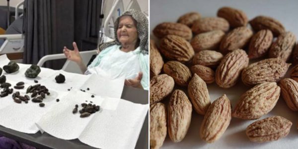 63 stones abdominal pain