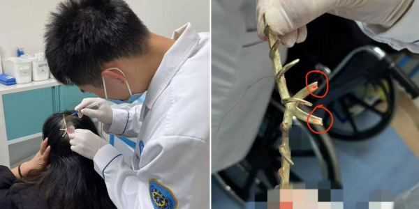 claw clip penetrates scalp