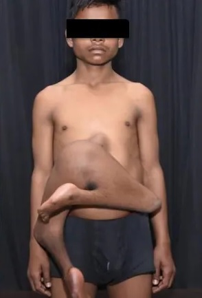 surgeons india parasitic twin pelvis