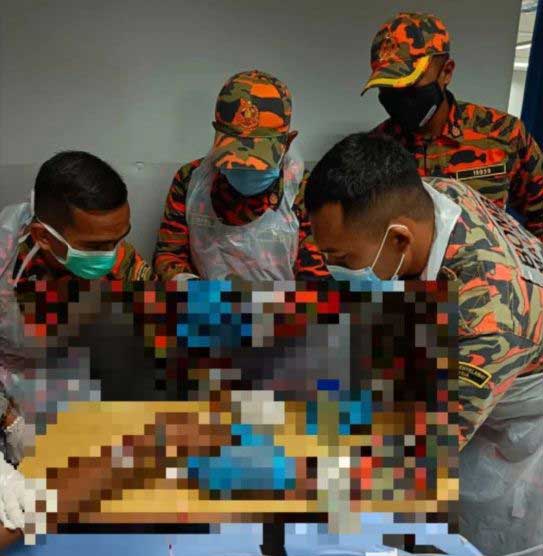 man fingers amputated