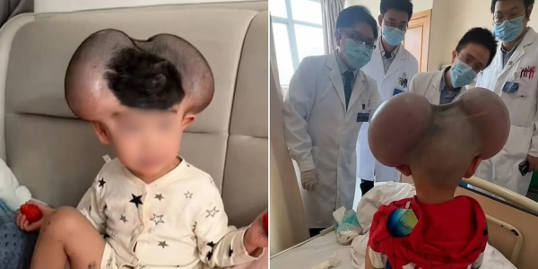 mickey mouse skin condition