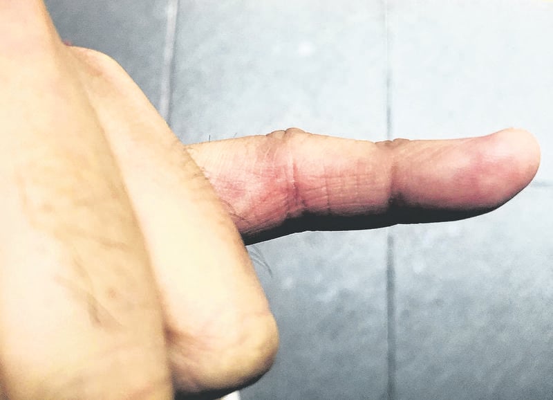man finger burned