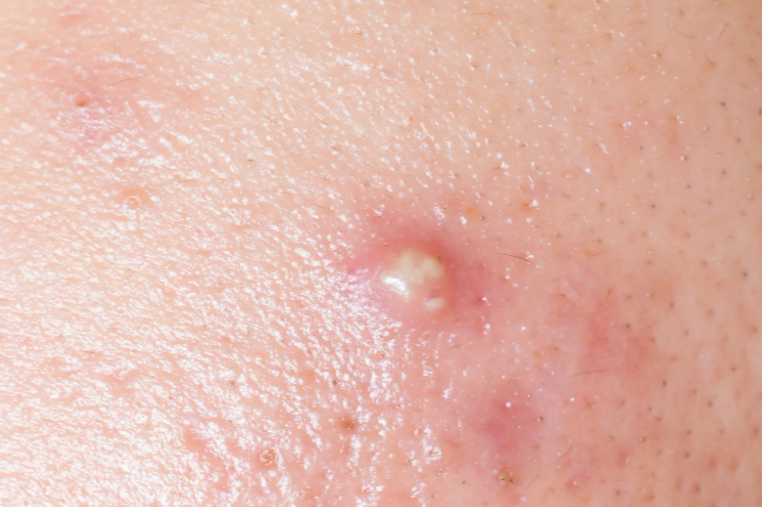 girl squeezing pimples vietnam