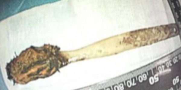 toothbrush lodged body