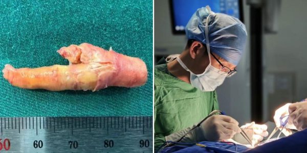 chicken foot-shaped plaque