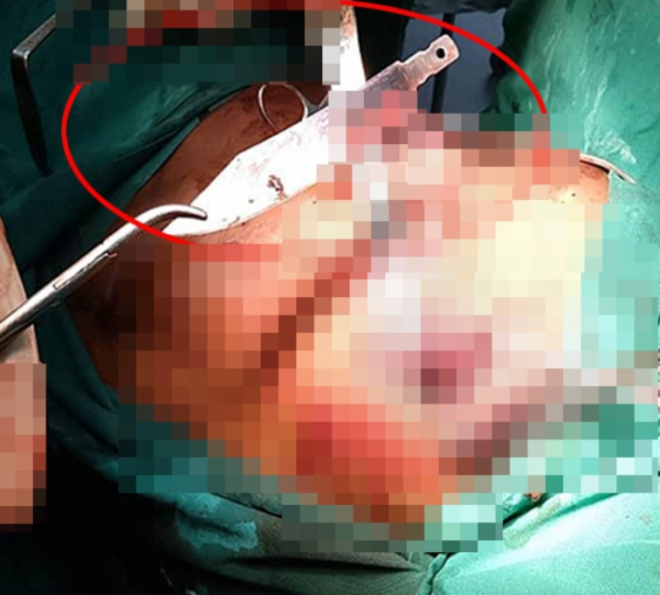 knife chest sore nipples