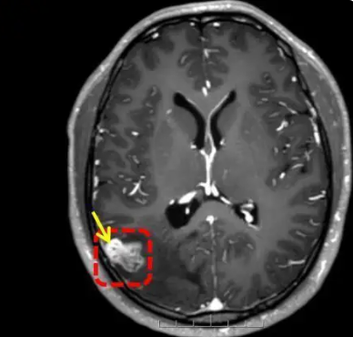 parasite worm mosaic vision