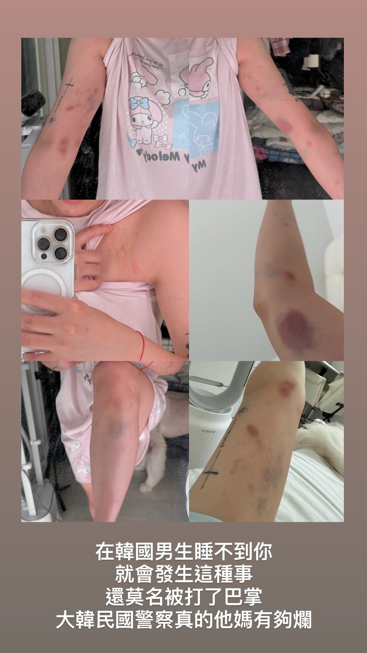 youtuber south korea bruises (1)