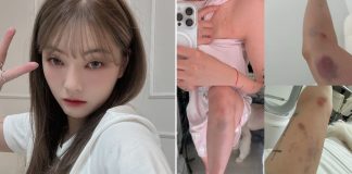 youtuber south korea bruises