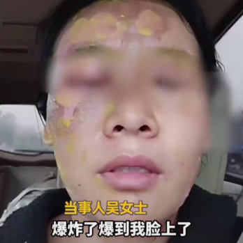 woman facial burns limescale