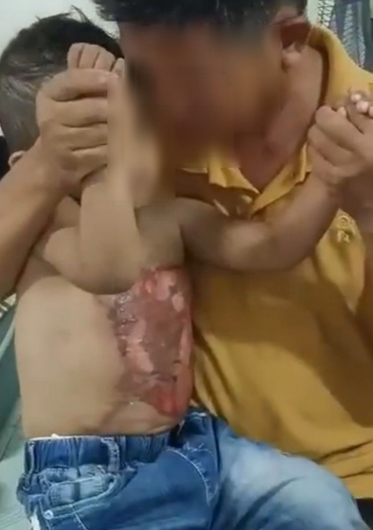three-year-old scalded boiling water