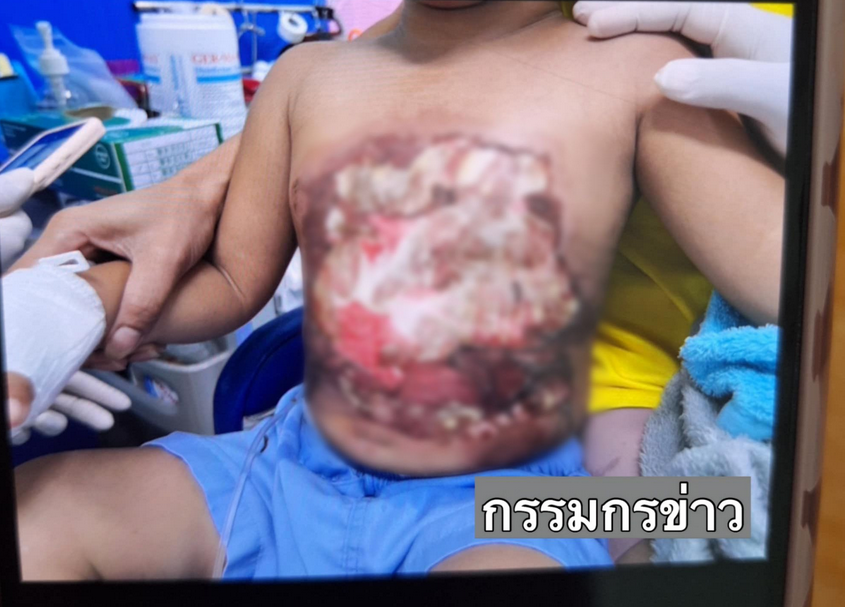 three-year-old scalded boiling water