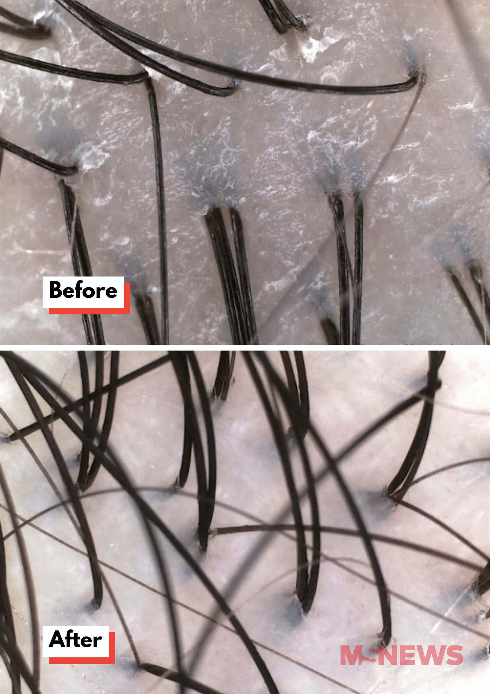 TK Trichokare results (1)