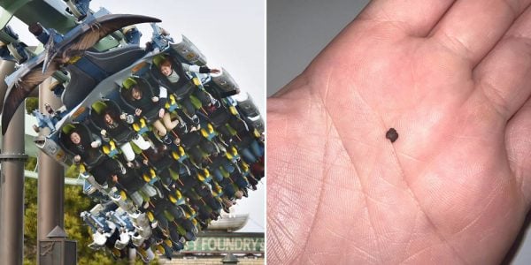 kidney stone roller coaster