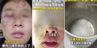 woman facial burns limescale