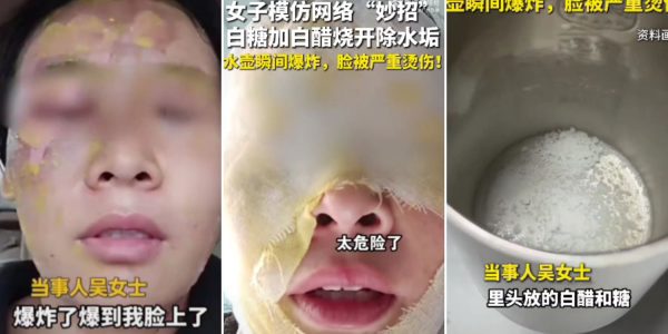 woman facial burns limescale