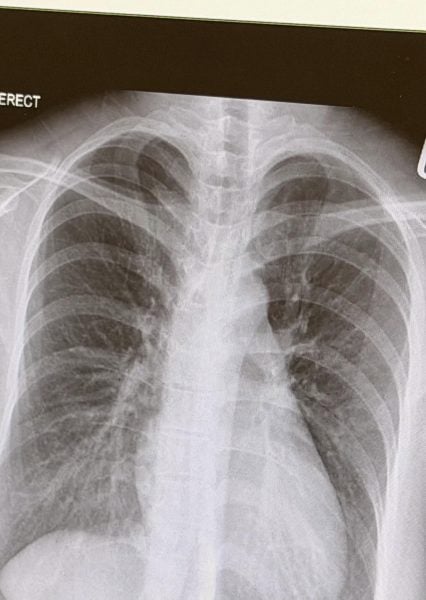 woman lung infection cough