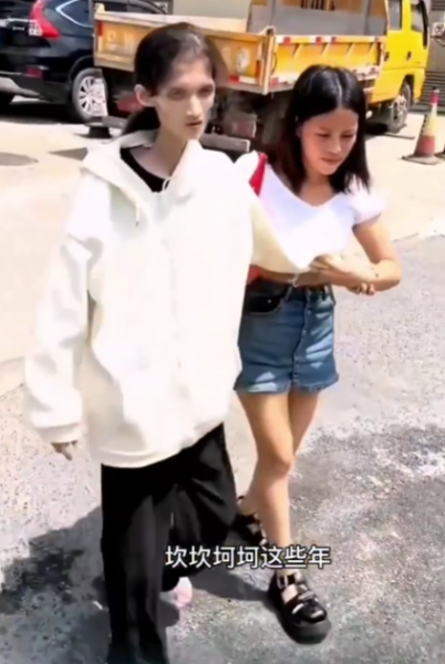 woman gastric atrophy